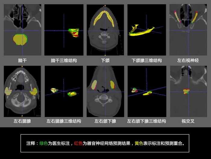 è…¾è®¯åŒ»ç–—AIæœ€æ–°ç ”ç©¶æˆæžœï¼Œç”¨æ·±åº¦å­¦ä¹ åˆ†å‰²å¤´é¢ˆç»„ç»‡åŒºåŸŸåŠ©åŠ›é¶å‘æ²»ç–—