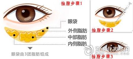 How to remove eye bags How to remove eye bags Liposuction eye bags Open to eye bags 1