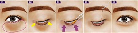How to remove eye bags How to remove eye bags Lips and eye bags Open to eye bags 2