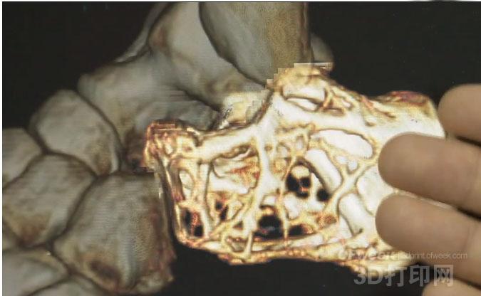 Dr. Han completed 3D printing of heel bone implant for the first time