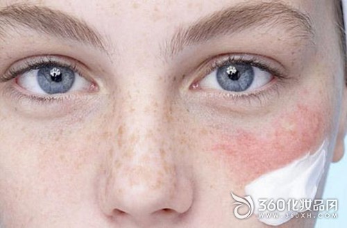 Autumn skin care battle, how to do it will not be allergic to the face? - sensitive skin