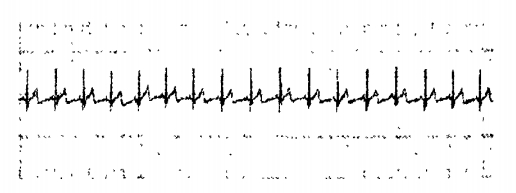 Received ECG signal