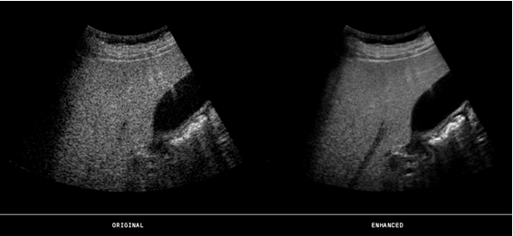 Ultrasound technique liver image