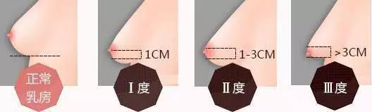 å“ºä¹³æœŸè¿‡åŽèƒ¸éƒ¨æ¾å¼›ä¸‹åž‚æ€Žä¹ˆåŠž  é¢„é˜²èƒ¸éƒ¨æ¾å¼›å¦™æ‹›