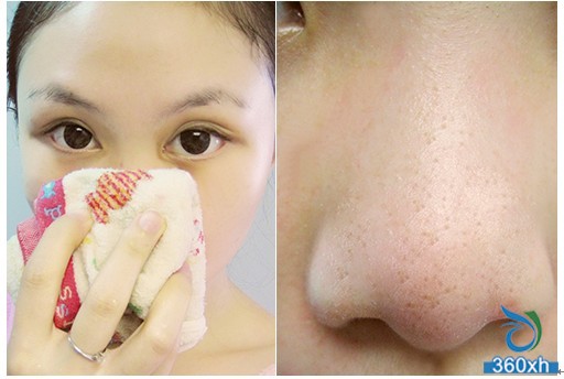 Blackhead