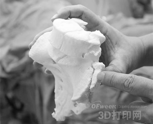 Zhaoqing City takes the lead in applying 3D printing technology to treat fractures