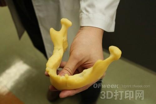 3D printing tibia model Successful treatment of oral cancer