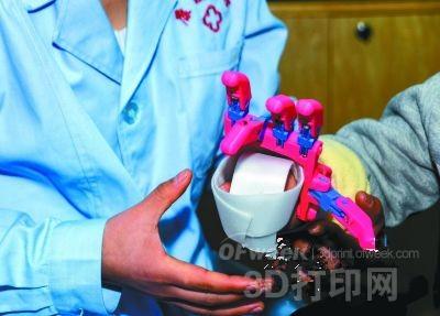 Meizhou's first 3D printed prosthesis debut (Figure)