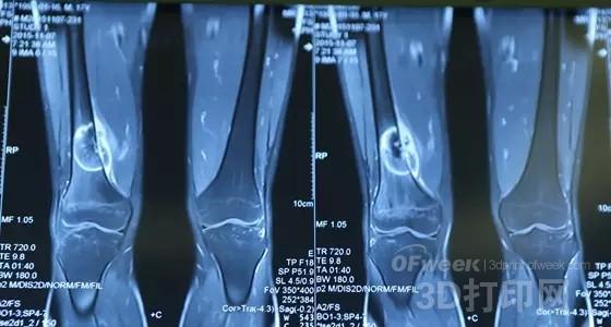 3D printing technology for the treatment of osteosarcoma