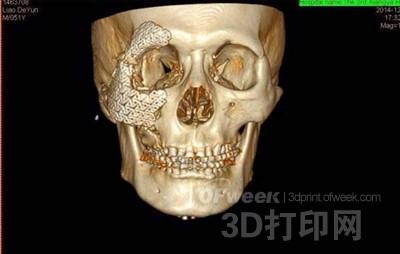 Inventory of domestic hospitals that have used 3D printing for clinical surgery