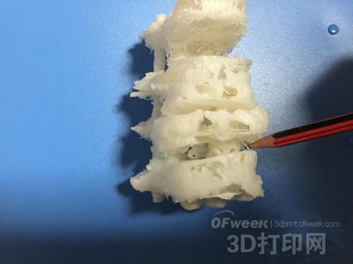 Yichang first applied 3D printing technology to complex high-risk spinal surgery