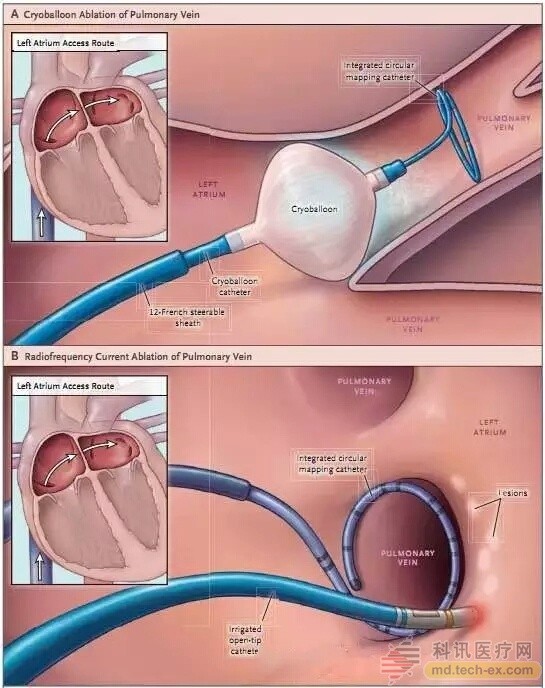 Frozen balloon ablation is not inferior to radiofrequency ablation