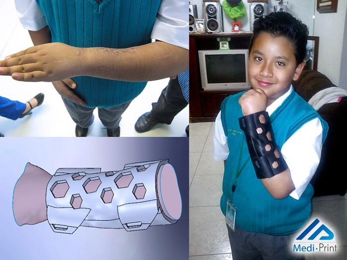 Lighter and safer 3D printed medical splint NovaCast