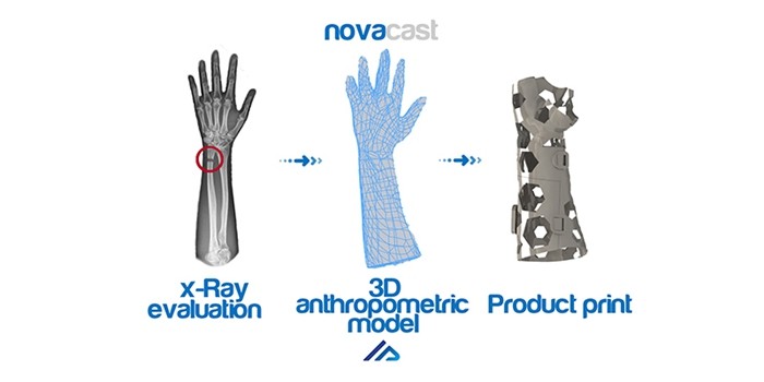 Lighter and safer 3D printed medical splint NovaCast