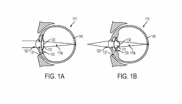 Implanting electronic devices into the eyeball to correct myopia