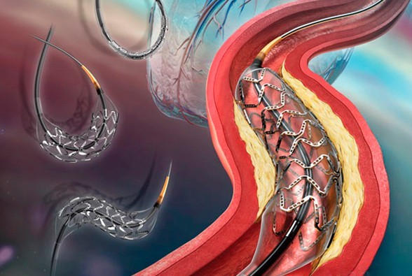 Three minutes to understand biodegradable stents