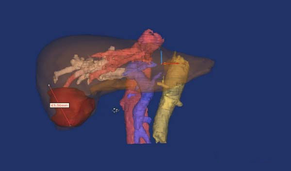 Hunan Provincial Cancer Hospital removes primary liver cancer with 3D printed guides