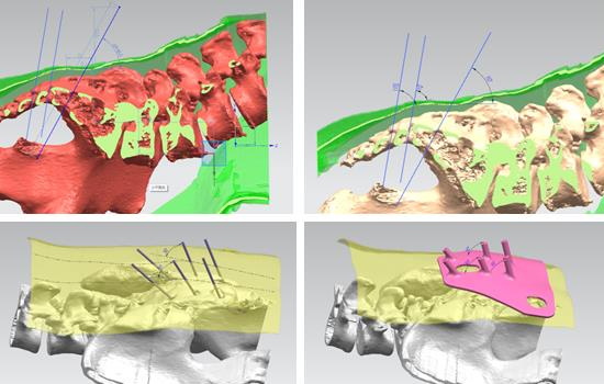 China's first successful application of medical 3D printing technology to treat urinary diseases