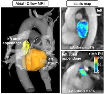 The latest MRI technology can determine the probability of stroke by imaging blood flow velocity