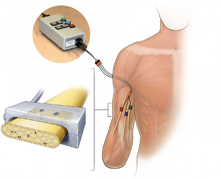 The amputee places the medical arm and regains the hand touch