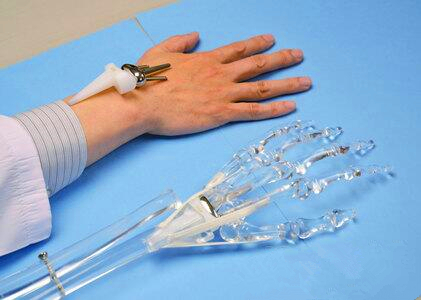 Japan successfully developed the first artificial hand joint for the treatment of rheumatism