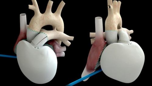 The fifth permanent artificial heart transplant in the world has passed away