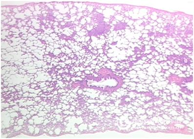 JCI: A prototype drug uses a new mechanism to treat lung cancer