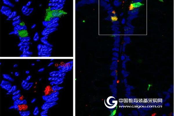 JCI: Parkinson's disease may originate in the intestines