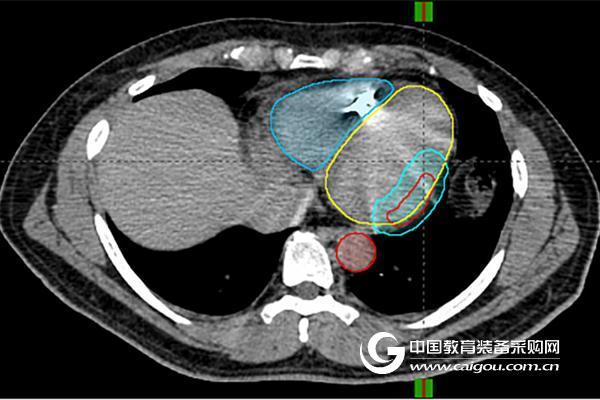 NEJM: Stereotactic radiotherapy can alleviate stubborn arrhythmia