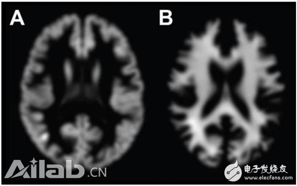 Deep learning technology can tell your doctor accurate brain age information in just a few seconds