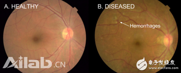 Google successfully used machine learning to detect diabetic retinopathy, which is comparable to ophthalmologists