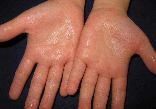 Hand, foot and hyperhidrosis