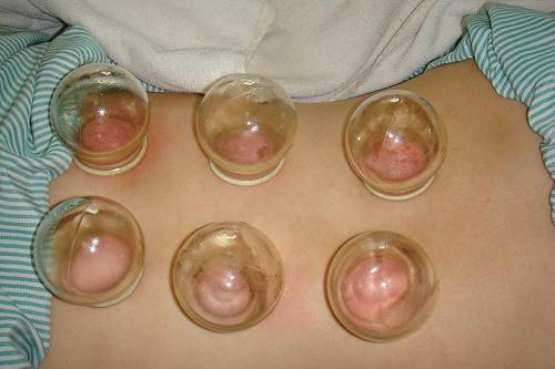 Chinese cupping therapy