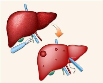More than 50% of non-cirrhotic liver cancer patients can survive for 5 years