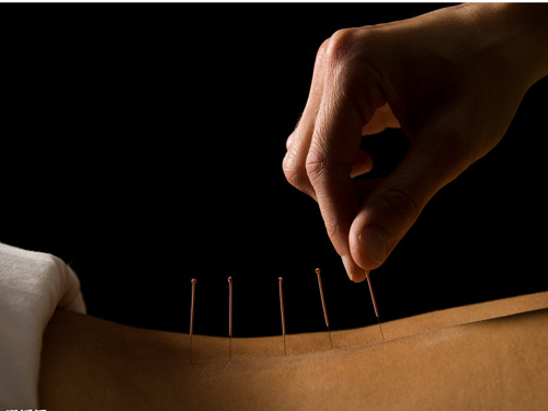 Three major factors in the surge of acupuncturists in the United States