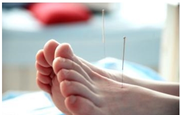 A brief history of acupuncture and acupuncture