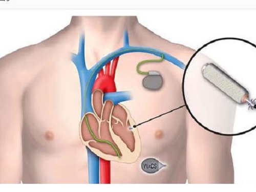 Mini Wireless Pacemakers Can Be Disapproved