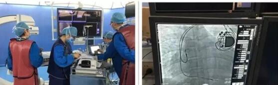 BonaFire cardiac pacing electrode wire used for the first time in Shanghai