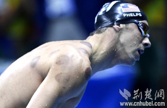Phelps is a "cupping enthusiast": Chinese medicine health care sports rehabilitation "artifact" (Figure)