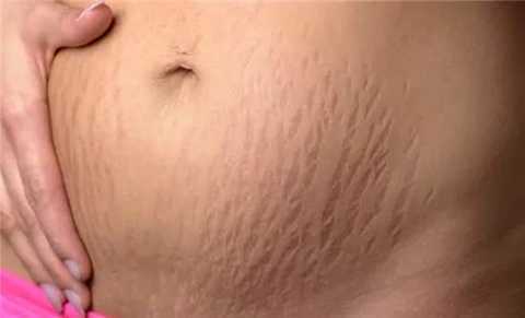 How to swallow the full stretch marks? Yi Yanxiu wears health to save you