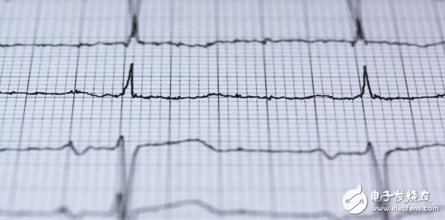 Artificial intelligence technology that can detect potential heart disease