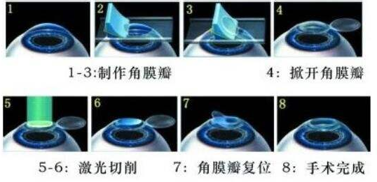 Myopia laser surgery: the difference analysis of excimer, femtosecond, and femtosecond