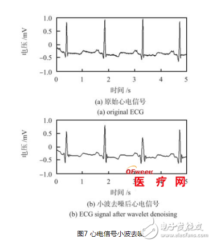 Detailed design of ECG signal detection system based on SoC FPGA