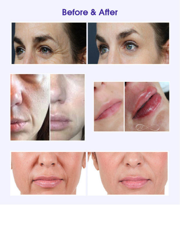 Best Selling Korea Hyaluronic Ha Dermal Filler CE Marked Wizfill No. 1.2.3 supplier