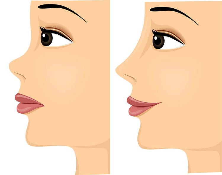 Neusdraadlift Nose Thread Lift