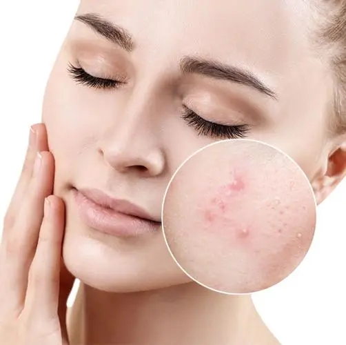 Anti-acne category Anti-acne category