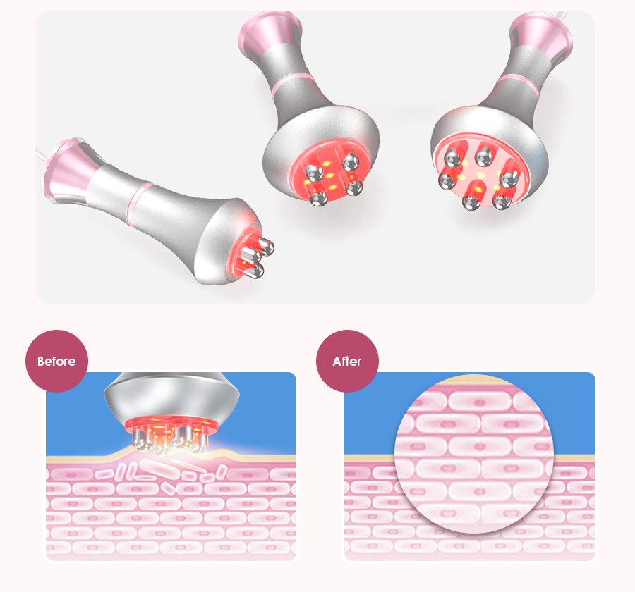 rf skin tightening rf skin tightening