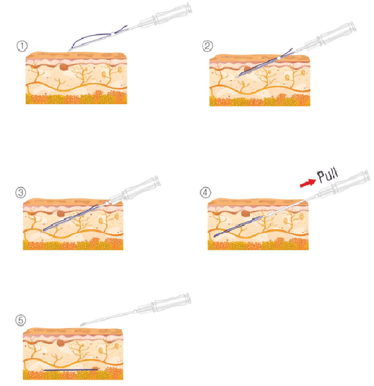 Thread Lift Thread Lift