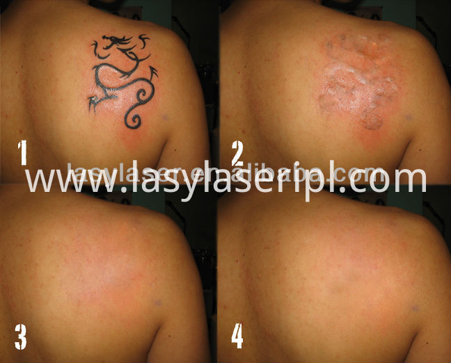 laser tattoo removal machine price china manufacturer laser tattoo removal machine price china manufacturer