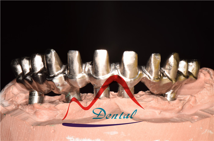 Nobel Dental Implant Bridge (3)